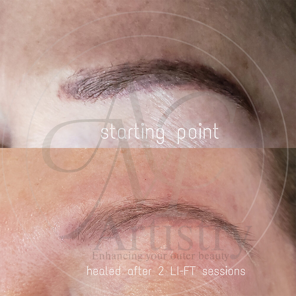 AMCartistry-LIFT-tattoo-removal-1