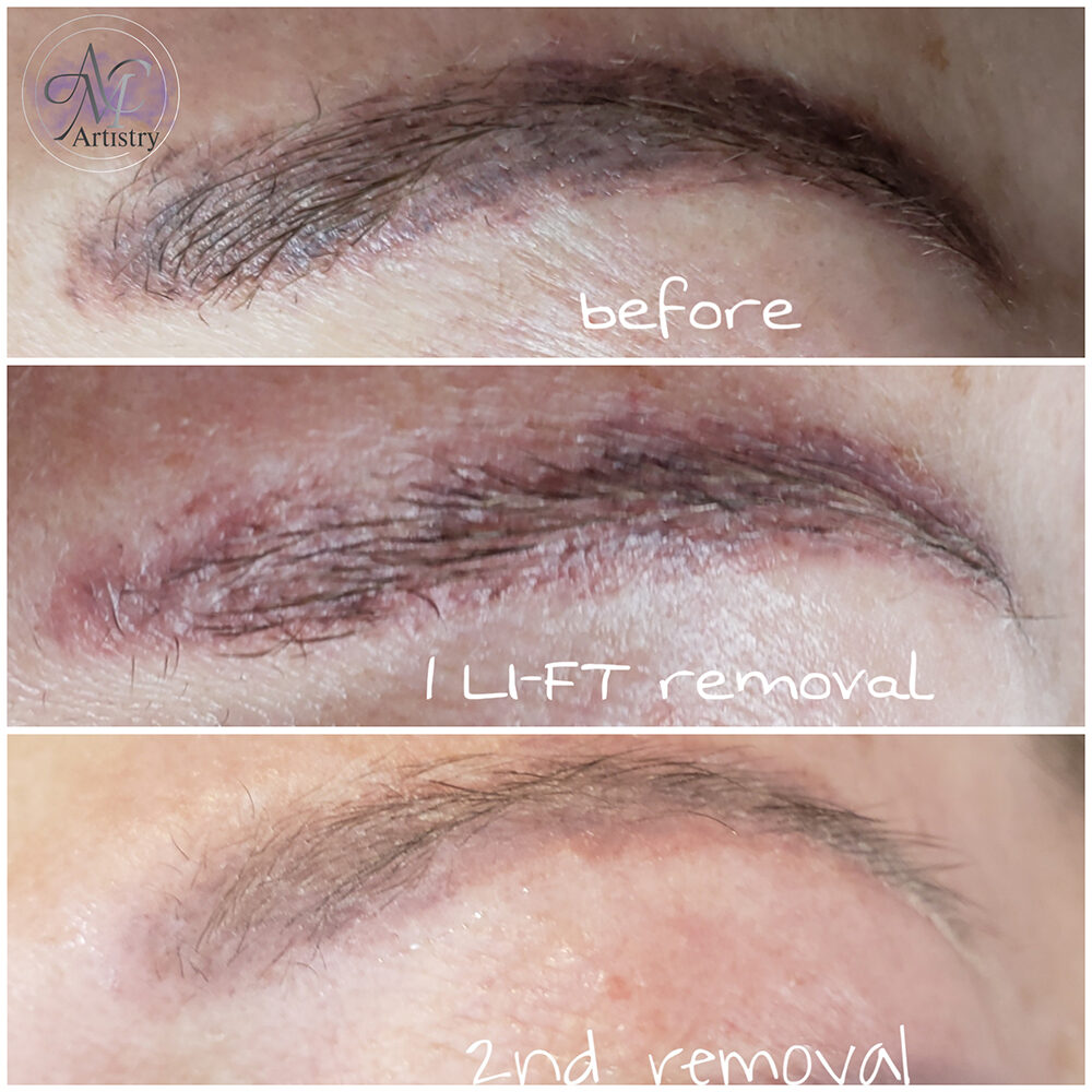 AMCartistry-LIFT-tattoo-removal-3